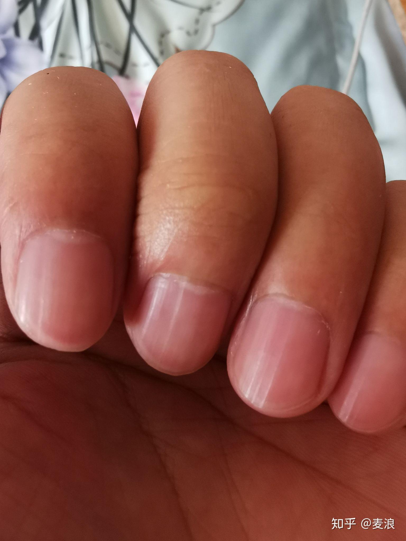 手指竖纹有月牙这是缺钙吗