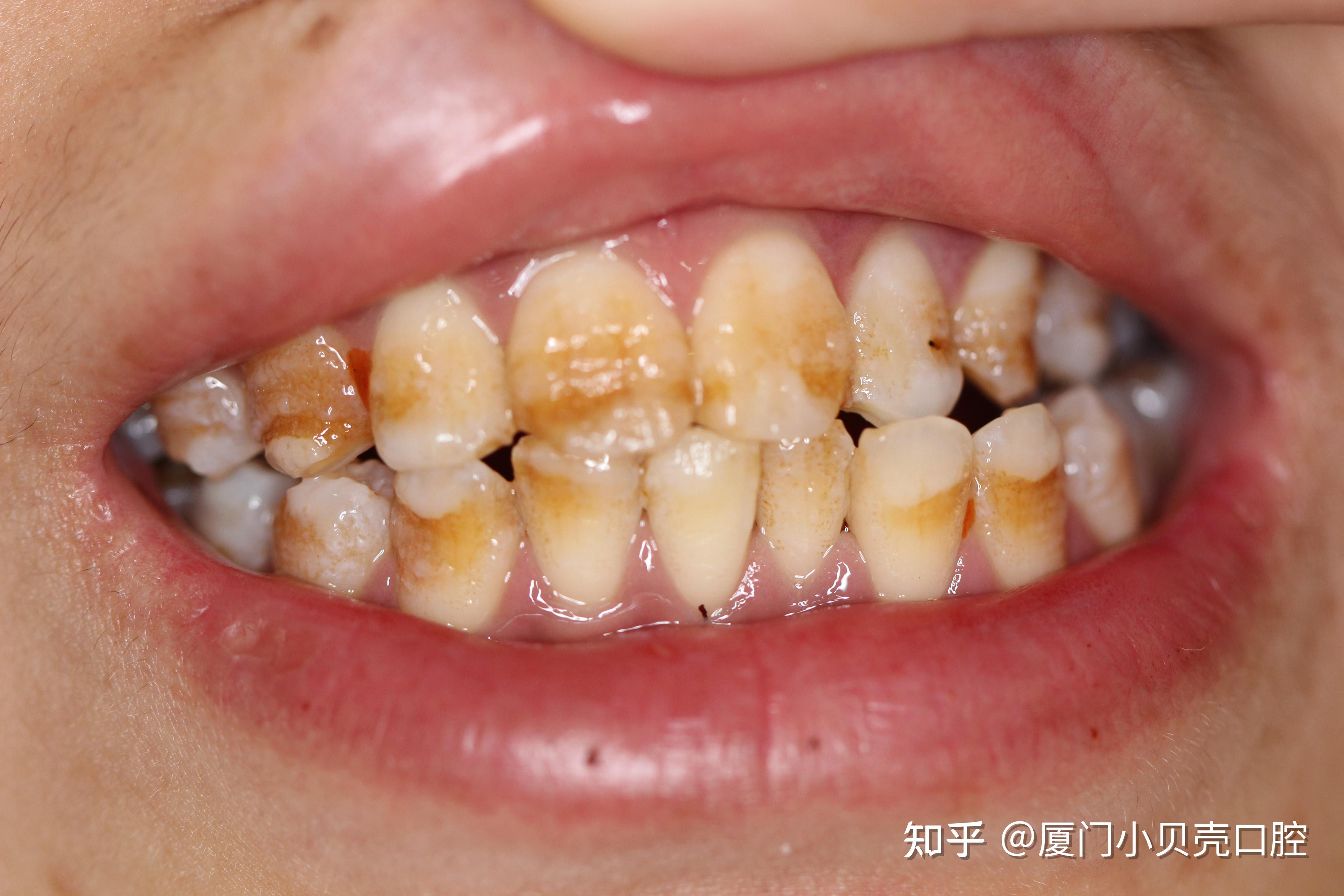 黄牙还有救吗? - 知乎