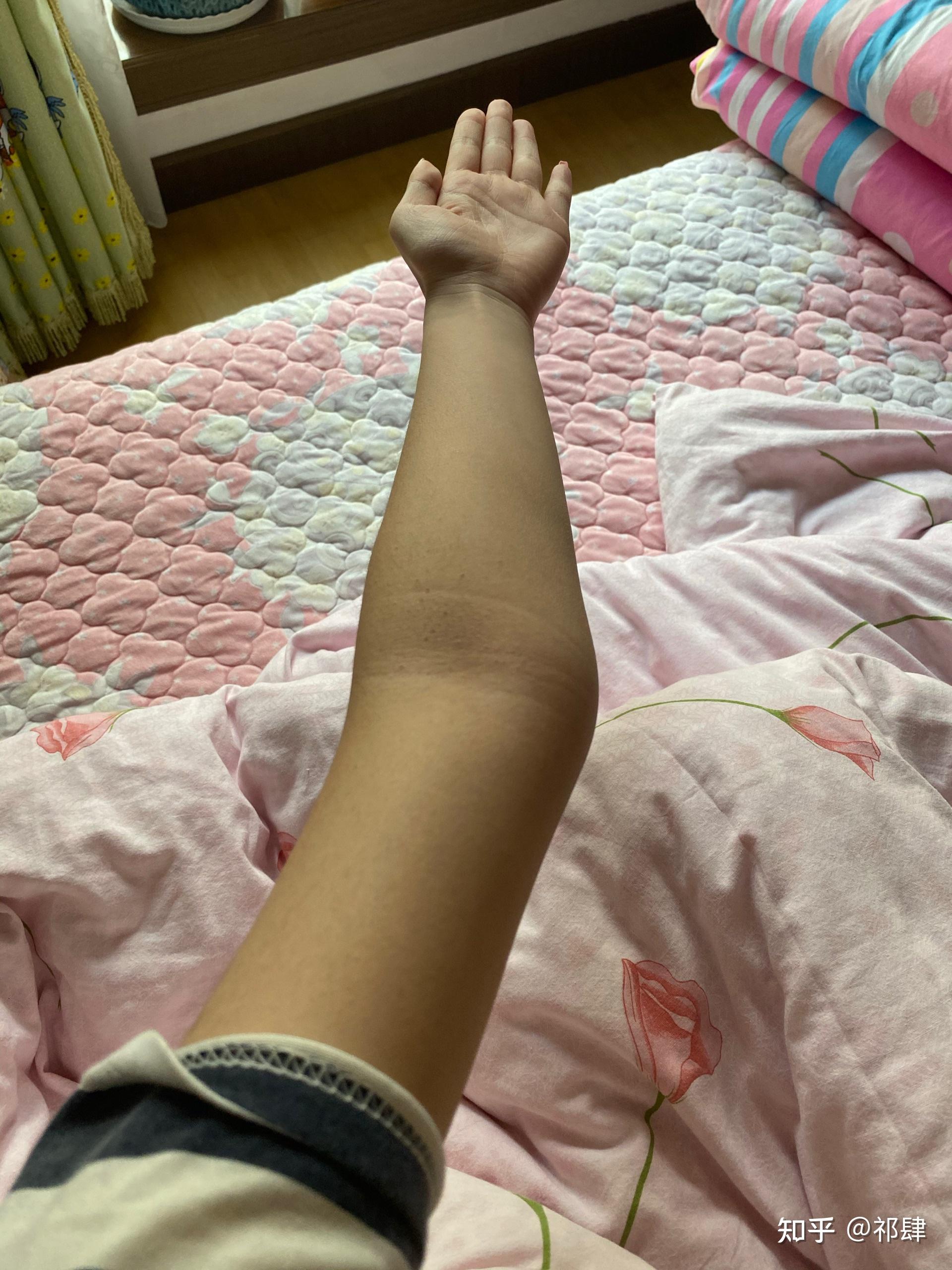 肘外翻是一种怎样的体验如图