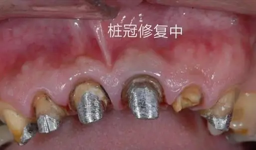 口腔牙体修复中,桩冠和桩核冠的区别? - 知乎