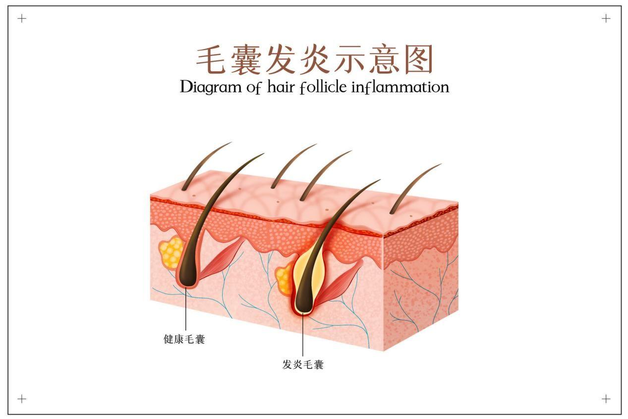 毛囊炎是什么,该怎么治疗呢? - 知乎