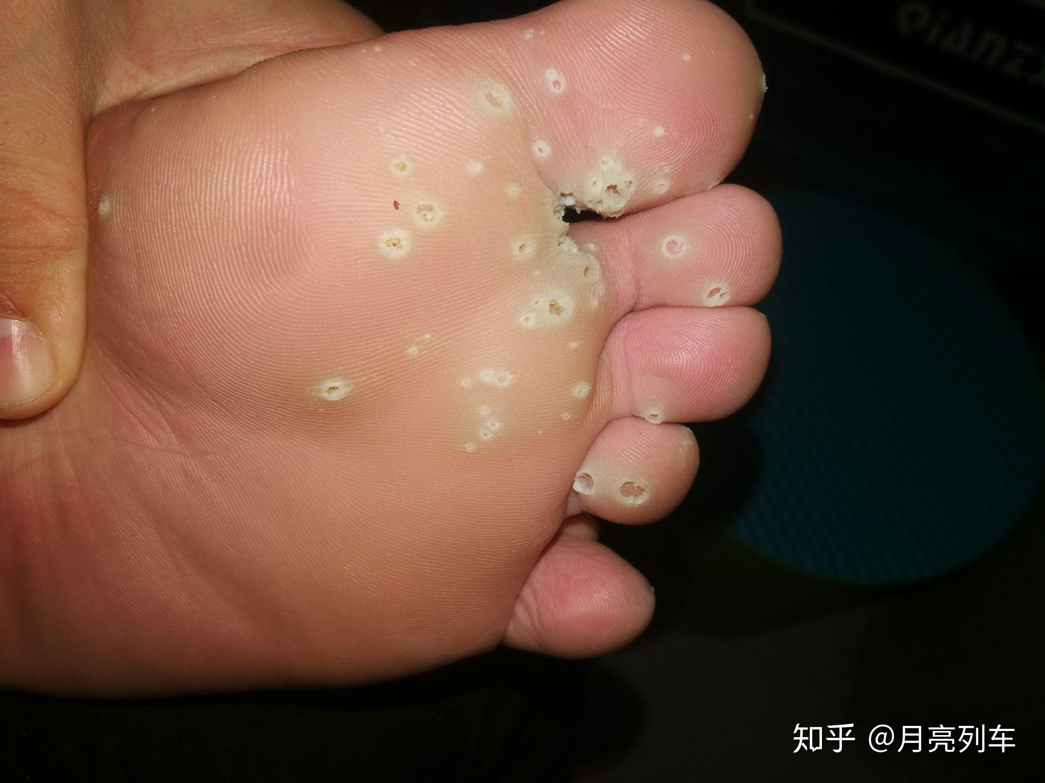 跖疣的自愈性大吗
