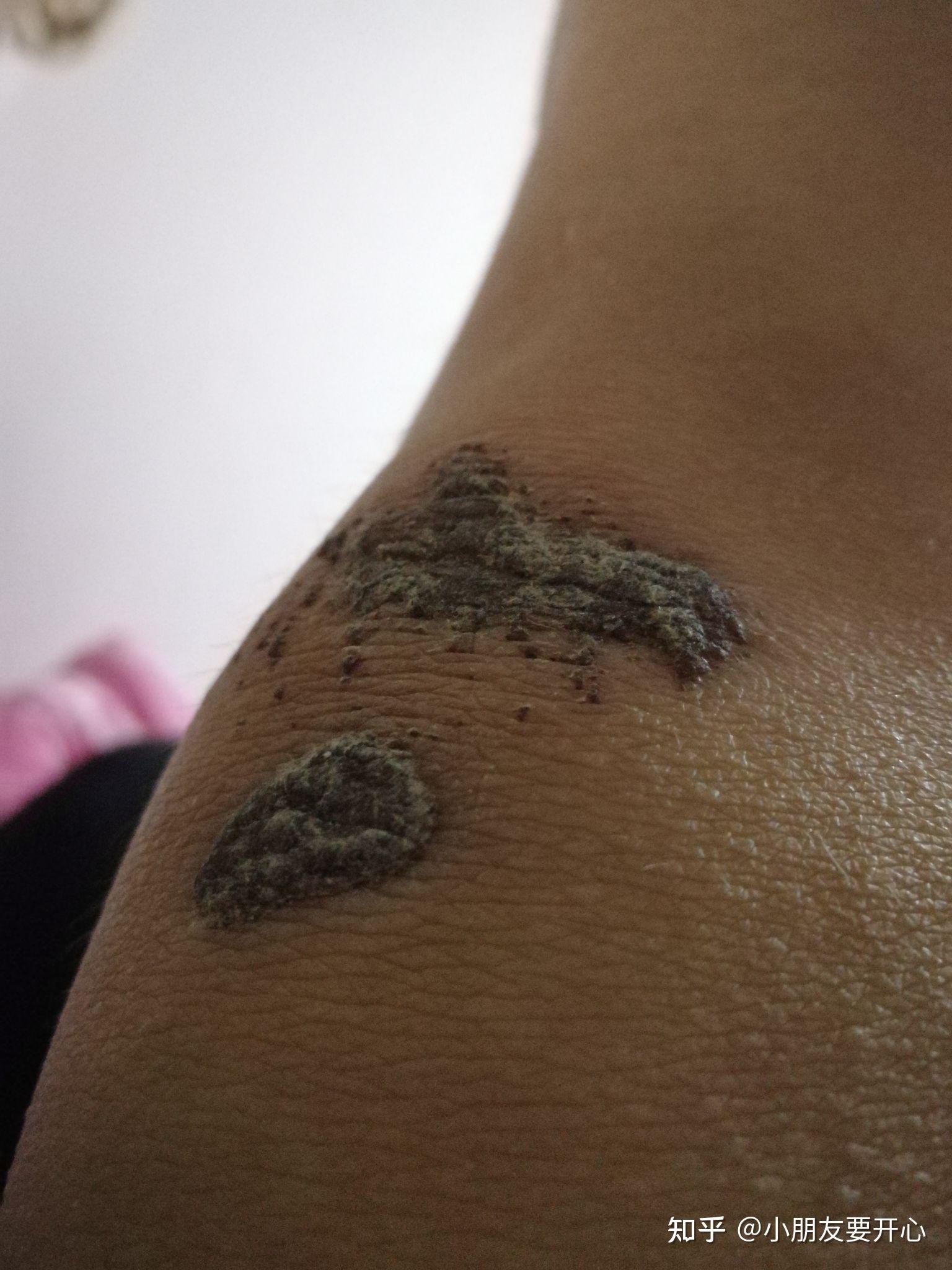 怎么才能让受伤后的结痂掉得快?