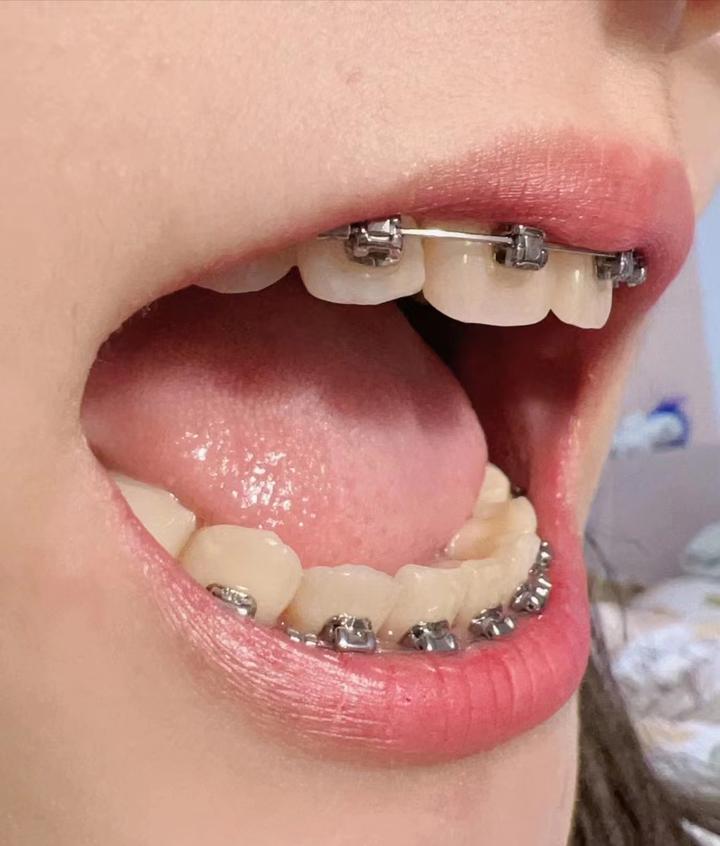 牙齿正畸首选钢丝牙套,为什么牙齿矫正金属牙套是最好的选择?