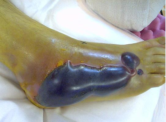 骨折后肿的都起水泡了该怎么办张力性水泡的那些事儿