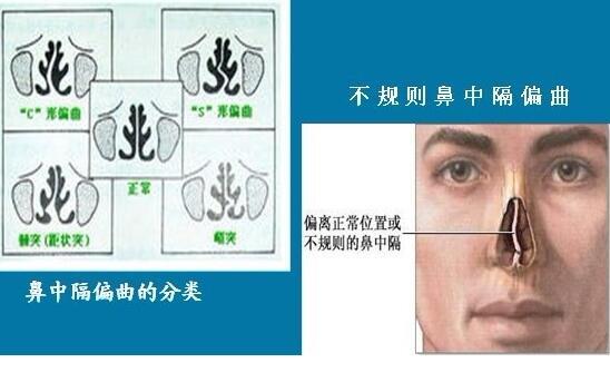 儿童鼻中隔患者的饮食禁忌