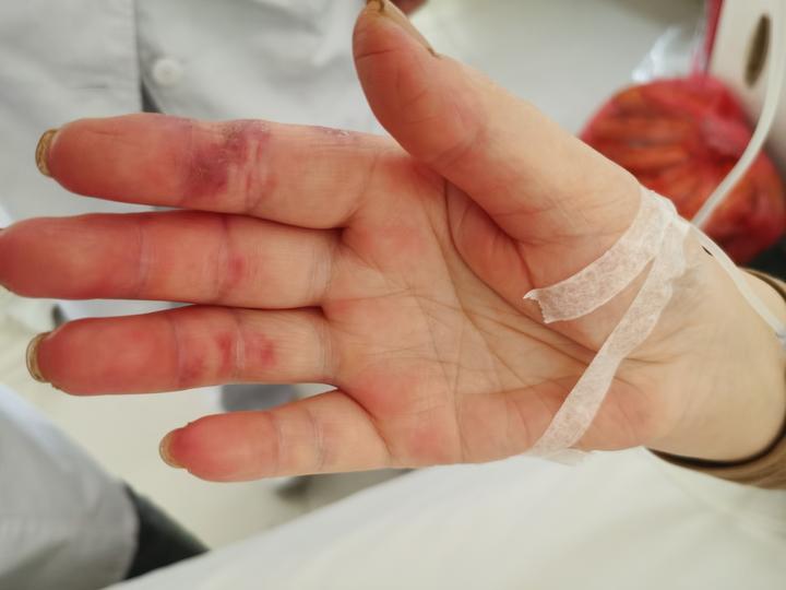 皮肌炎 | 肌肉萎缩是怎么发生的?多久能恢复正常体力?