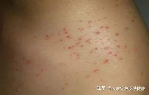 背上长痤疮？可能是马拉色菌毛囊炎！ - 知乎