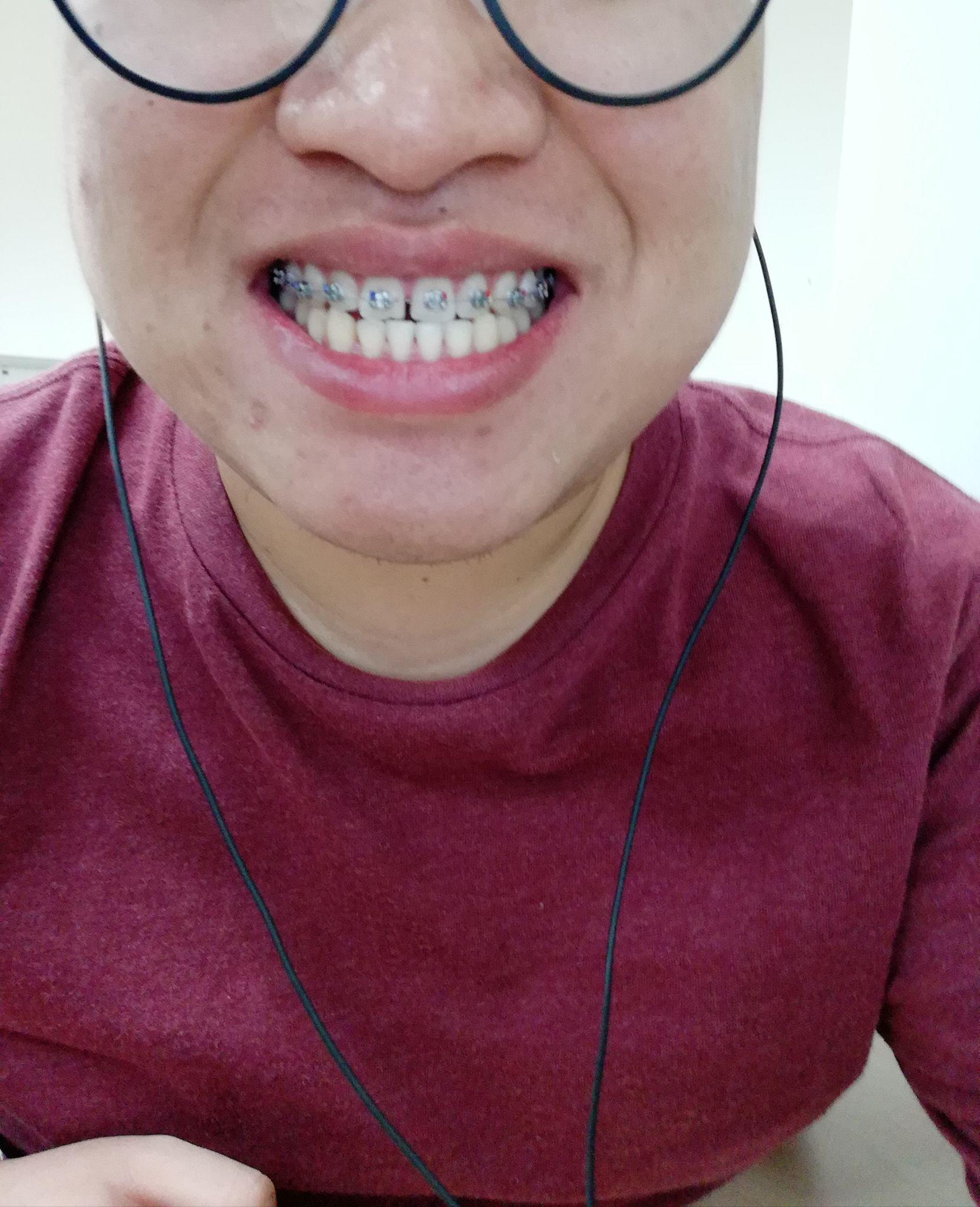 门牙缝隙很大是一种什么样的感觉