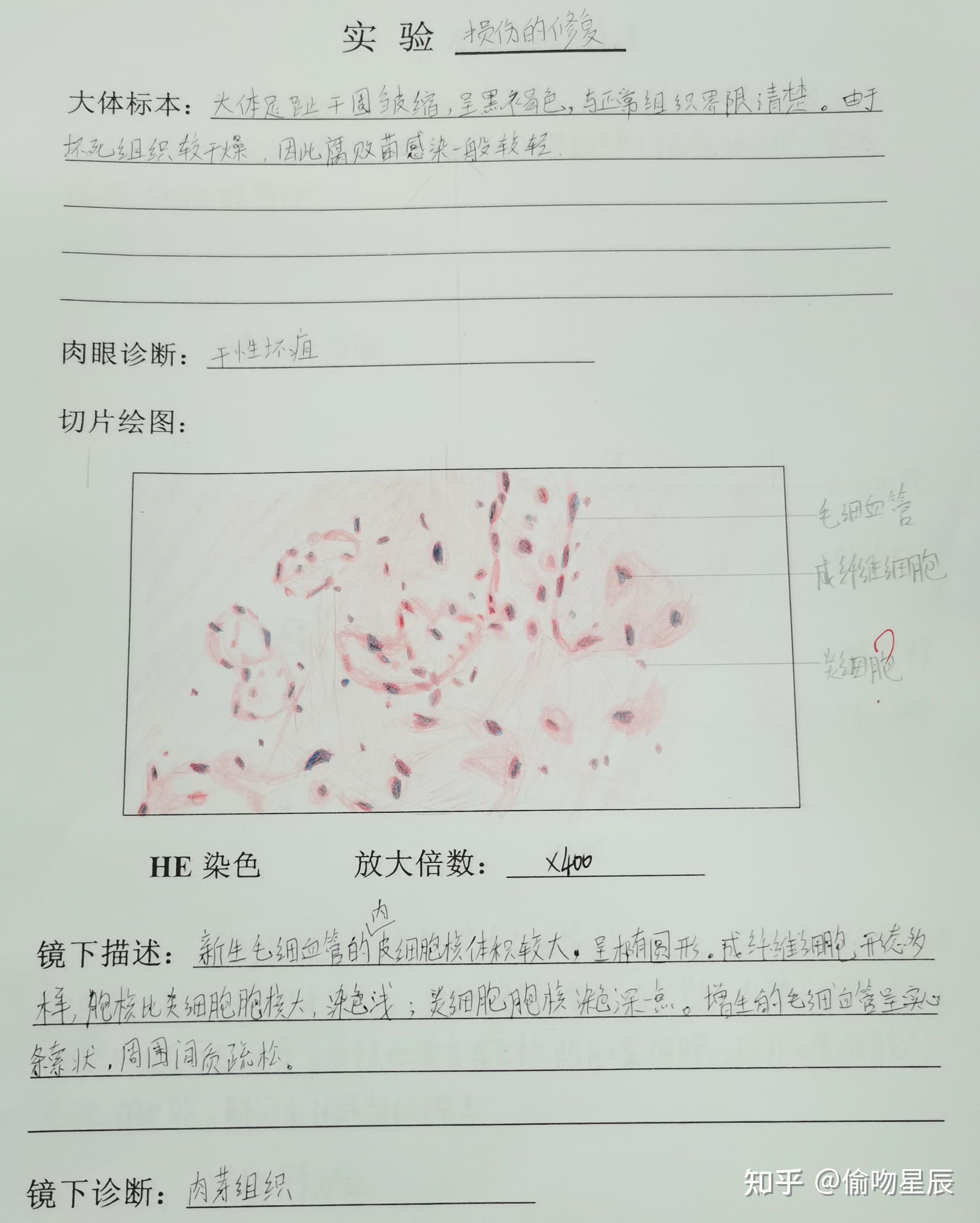 有没有人有病理的结肠腺癌红蓝铅笔手绘图啊? - 知乎