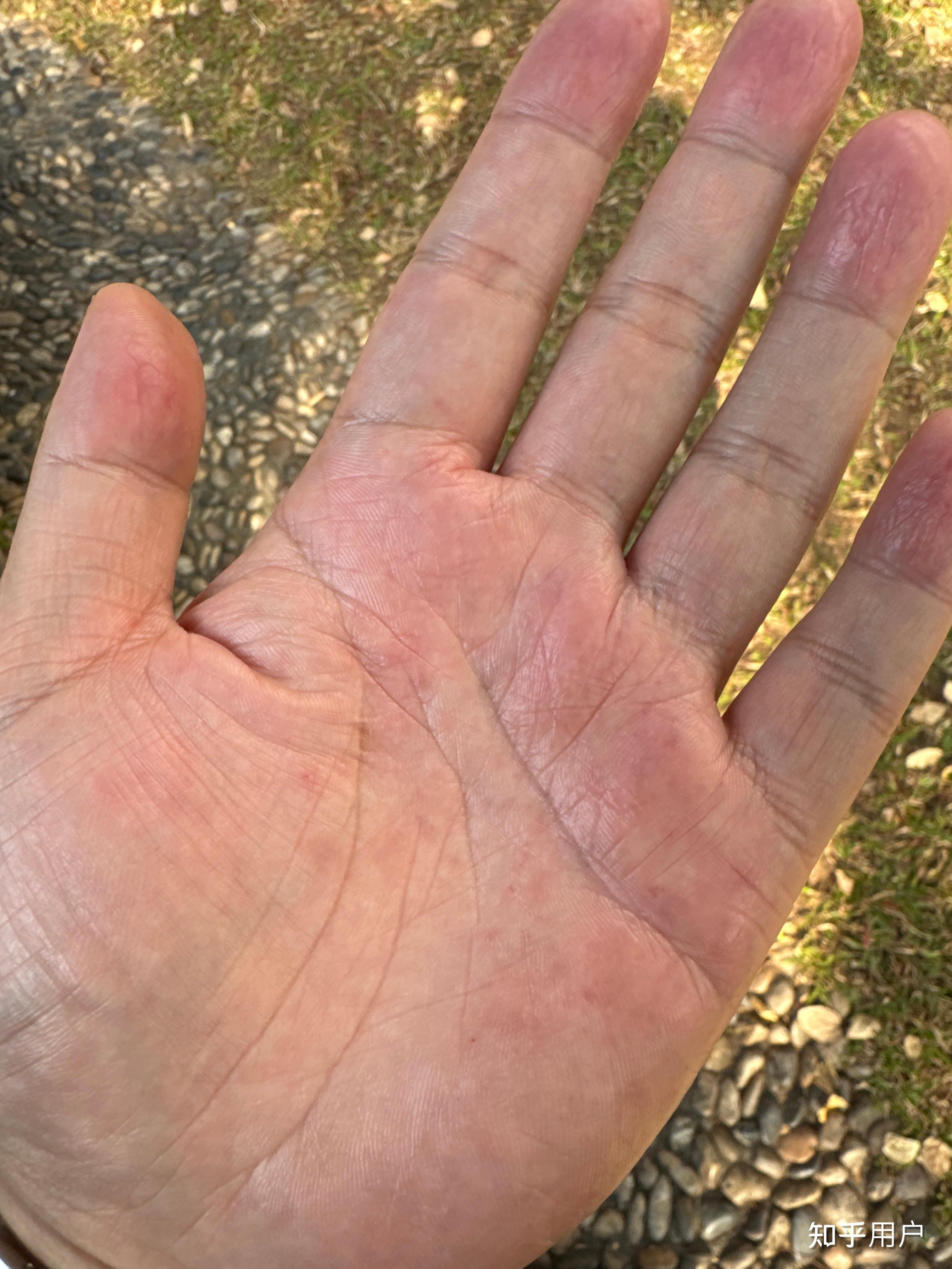 手掌就呈现红色的斑块,会痒,摸起来也比较硬,手指会脱皮,据说是汗疱疹