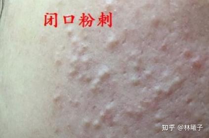 你脸上长的一粒一粒的小疙瘩是什么?是闭口粉刺还是毛周角化?怎么让处理? - 知乎