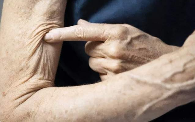 老年人「肌少症」有多可怕?跌倒后可能丧失生命 - 知乎