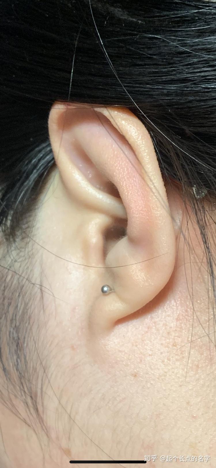 耳朵有褶皱表示有心脏疾病吗? - 知乎