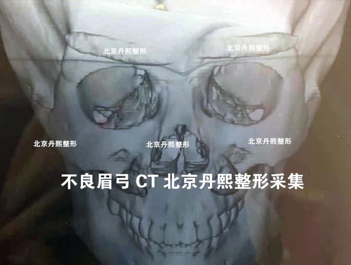 如何避免假体垫眉弓以后出现张飞眉?不良眉弓形态CT展示 - 知乎