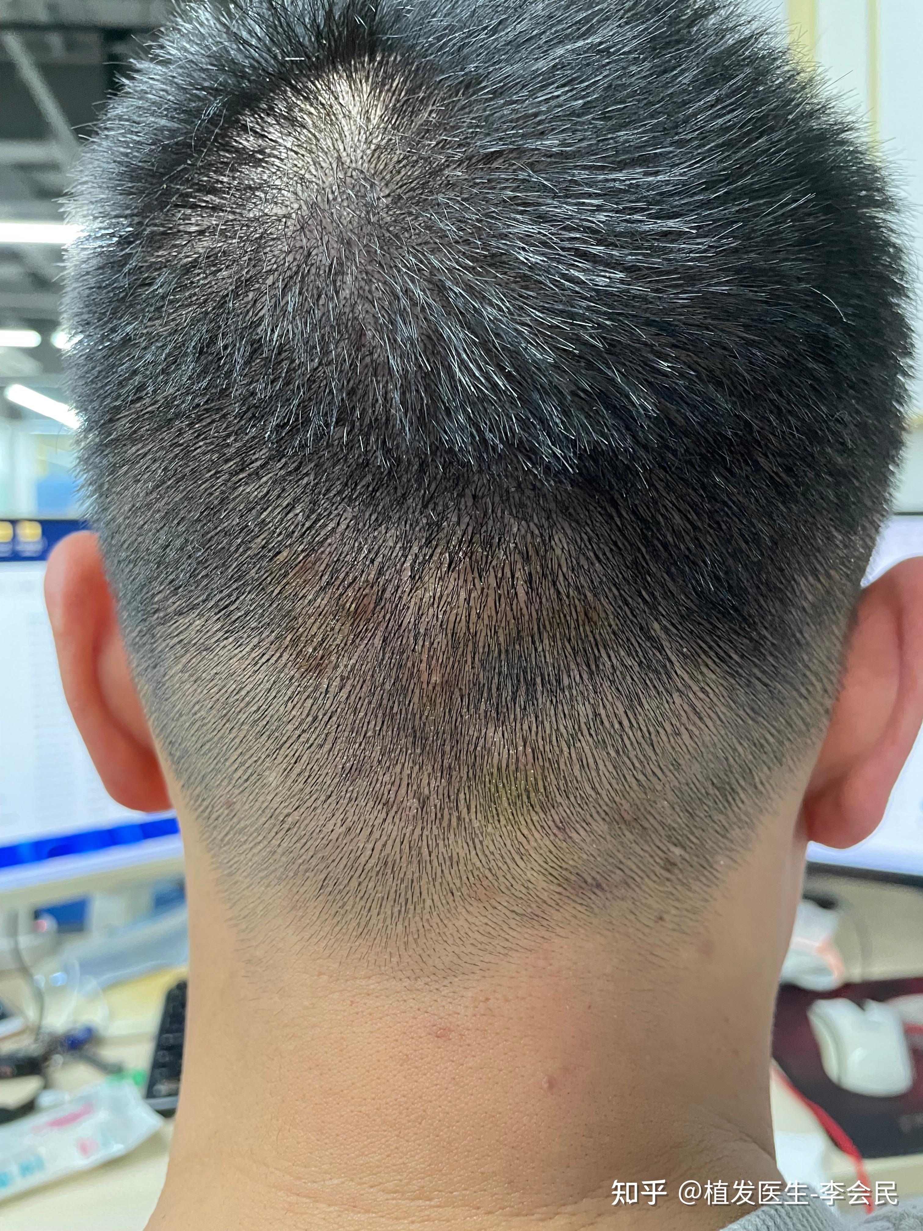 毛囊炎具体是什么样的