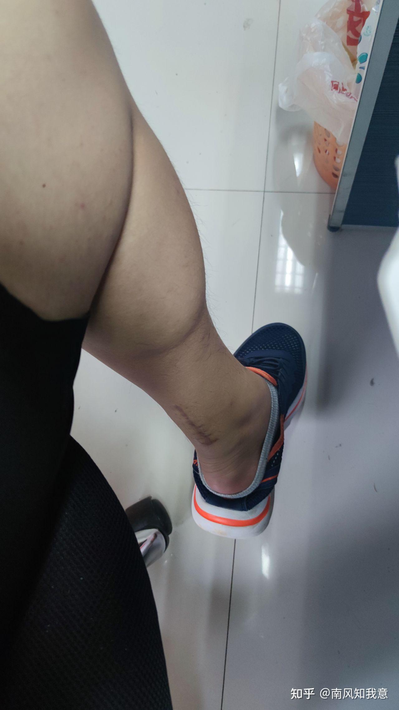 右手手腕韧带损伤比较严重以后还能打篮球吗