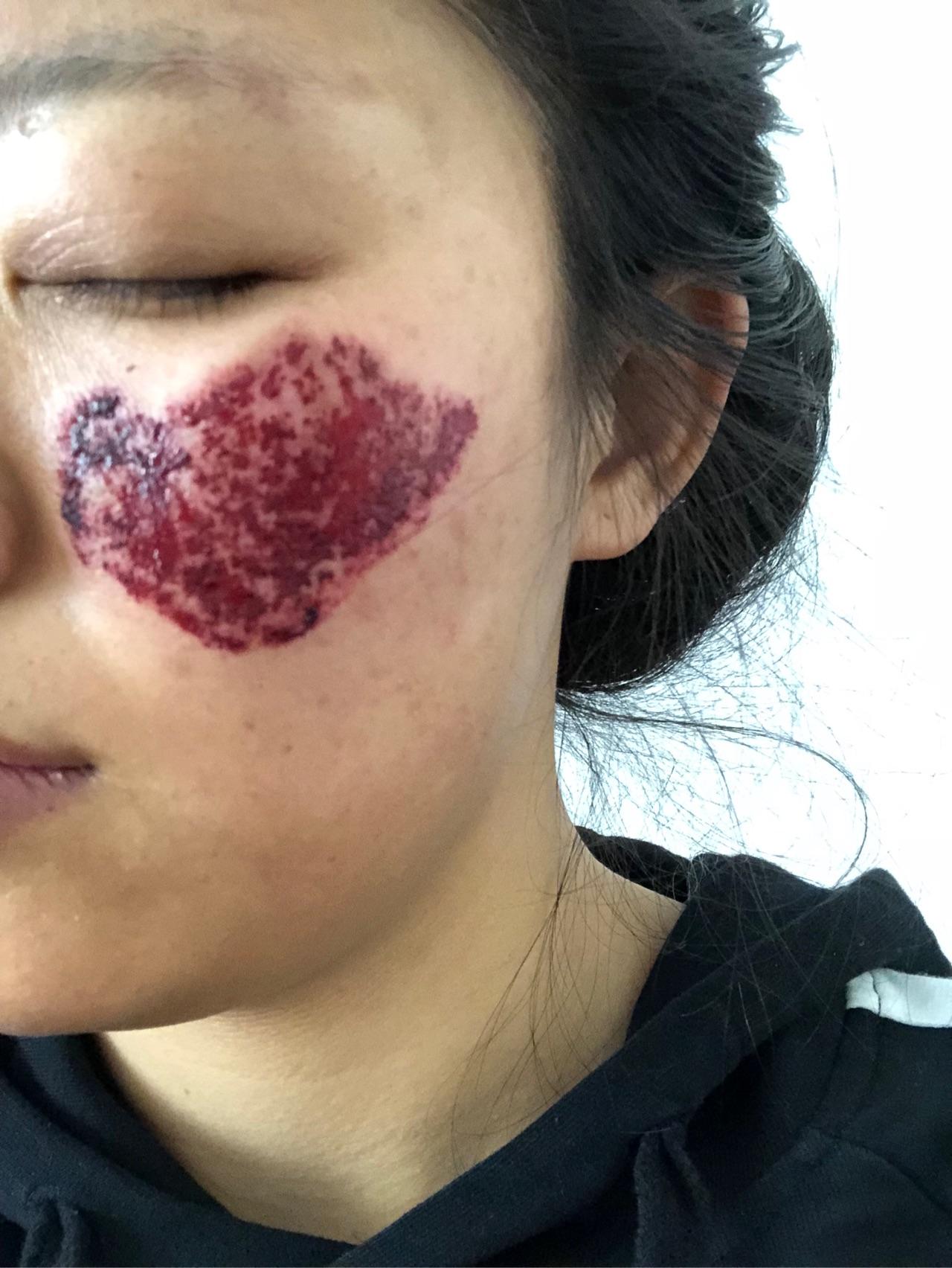 有人激光治疗过颧骨褐青色痣吗? - 知乎