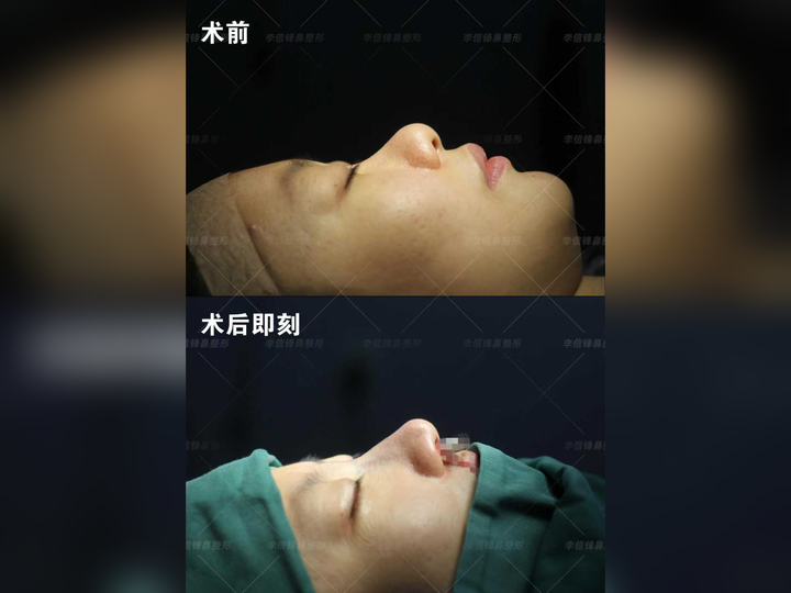 初鼻鼻综合-塌鼻梁、大鼻头改善案例,术后即刻对比~ - 知乎