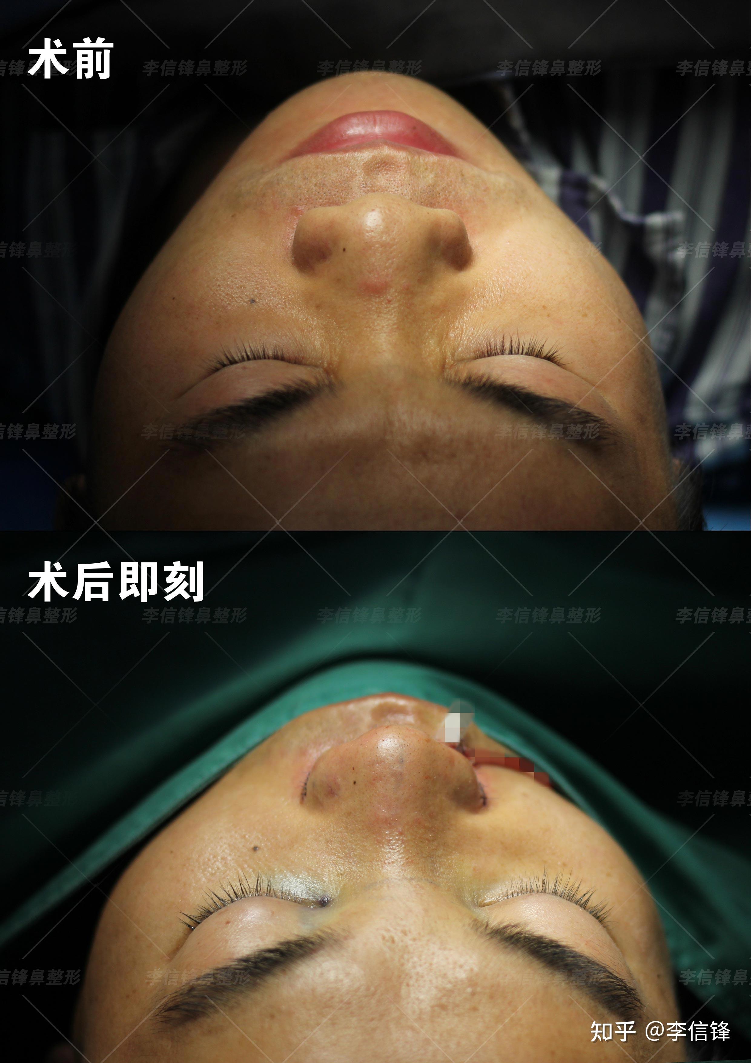 男士初鼻鼻综合案例,短塌鼻、鼻基底凹陷改善,术后即刻案例~ - 知乎