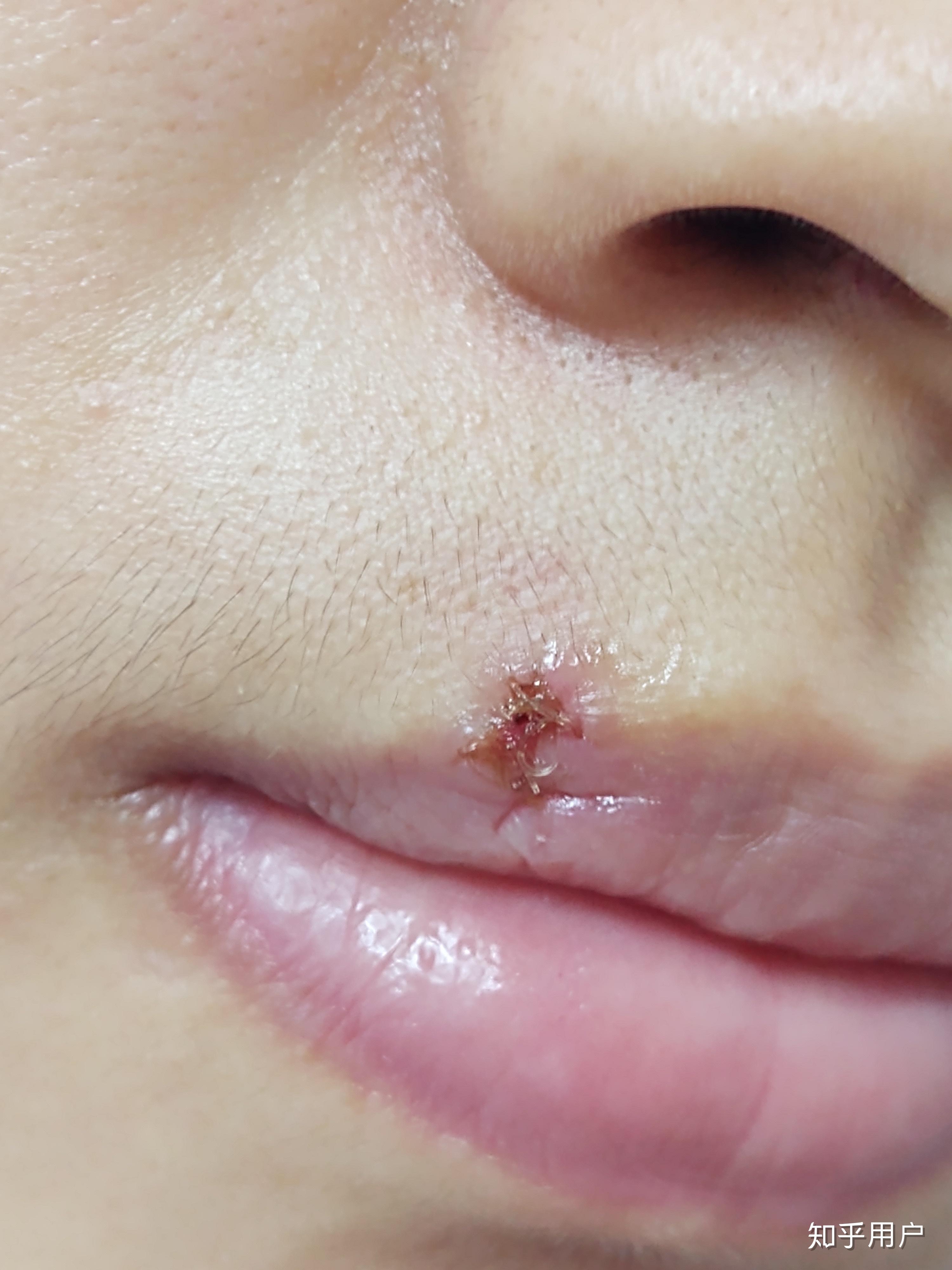 嘴唇上长痣怎么办 能不能点?