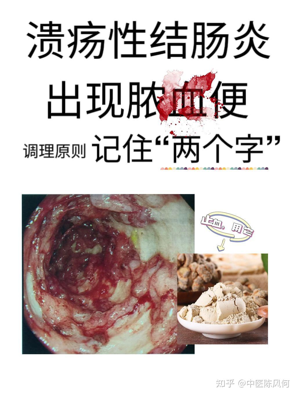 溃疡性结肠炎出现脓血便,马上用它就好 - 知乎