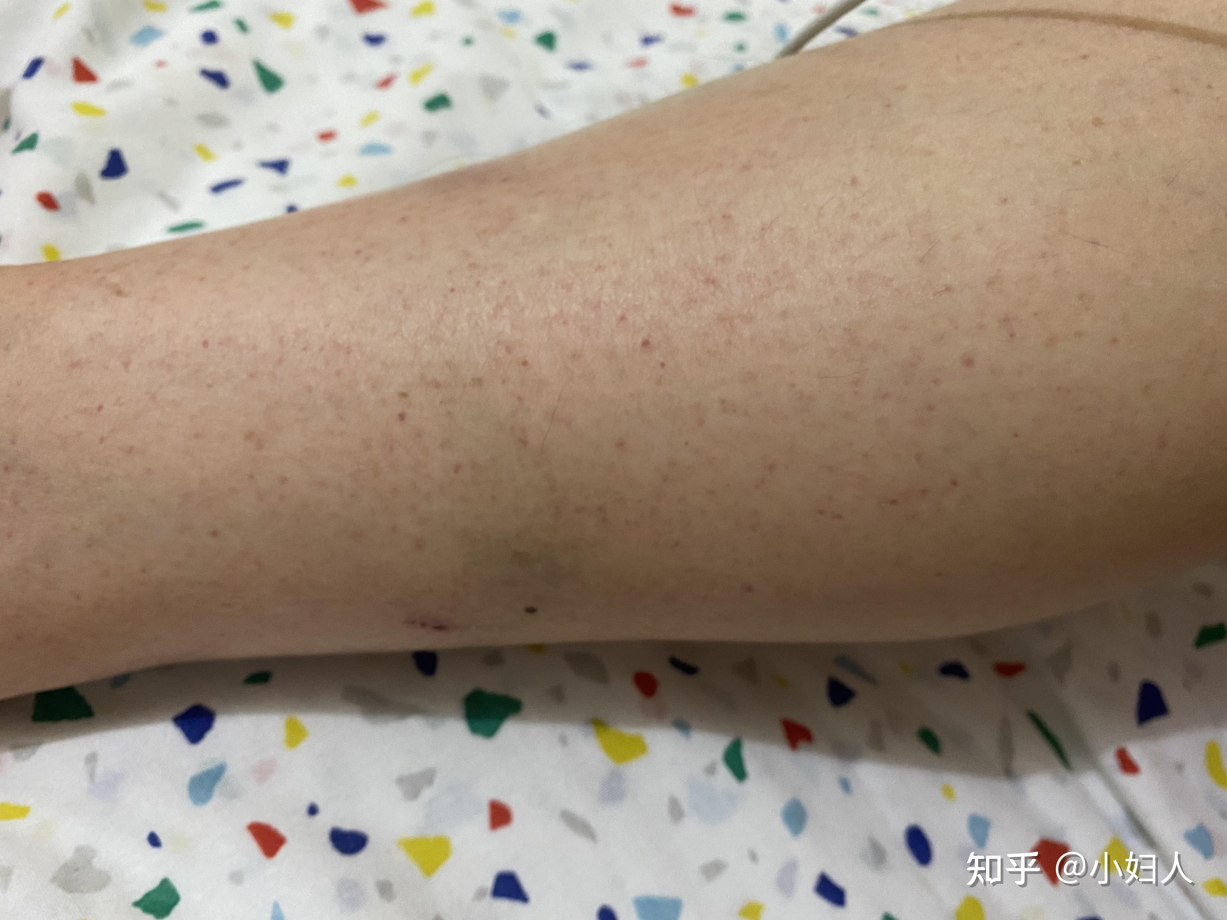 荨麻疹血管炎是很严重的病吗有得同样病的人吗