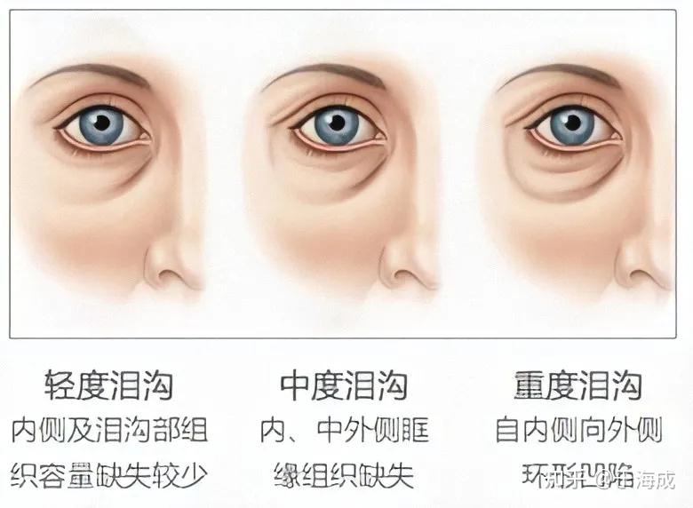 泪沟凹陷很显老?分型分治搞清楚了!别白浪费钱! - 知乎