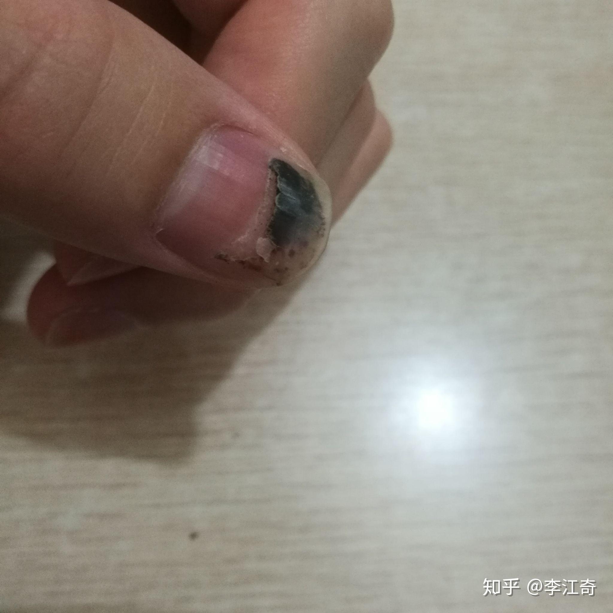 手指头被夹伤后,你是什么样的感受,怎么处理的? - 知乎