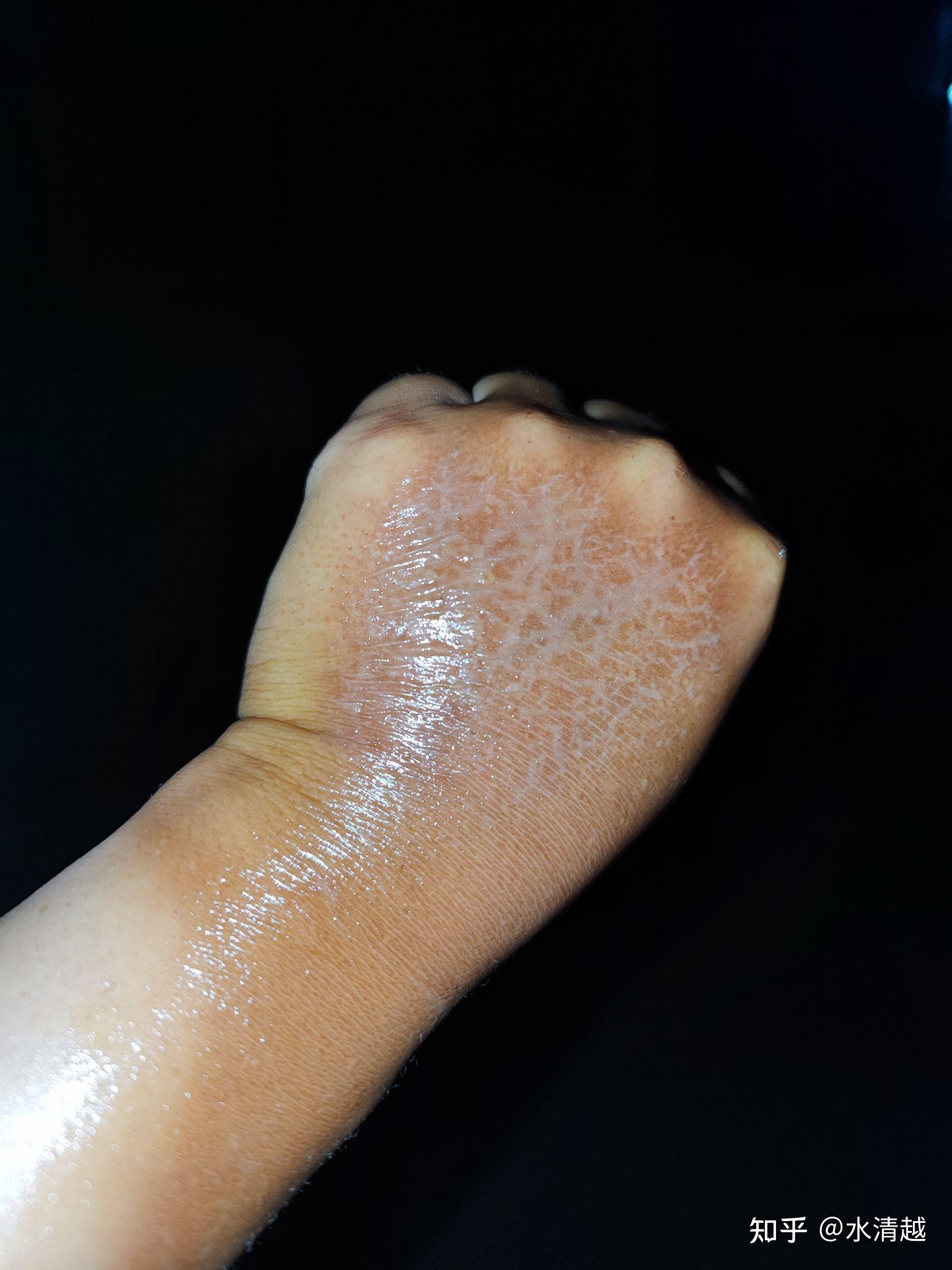 晒伤了啥症状我这样算晒伤吗