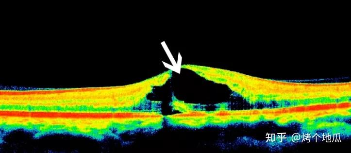 眼部oct检查怎么看? - 知乎