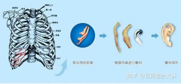 耳软骨再生图片