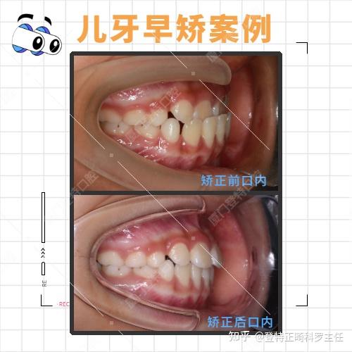 儿童牙齿早期干预戴mrc肌功能矫正器到底什么价位