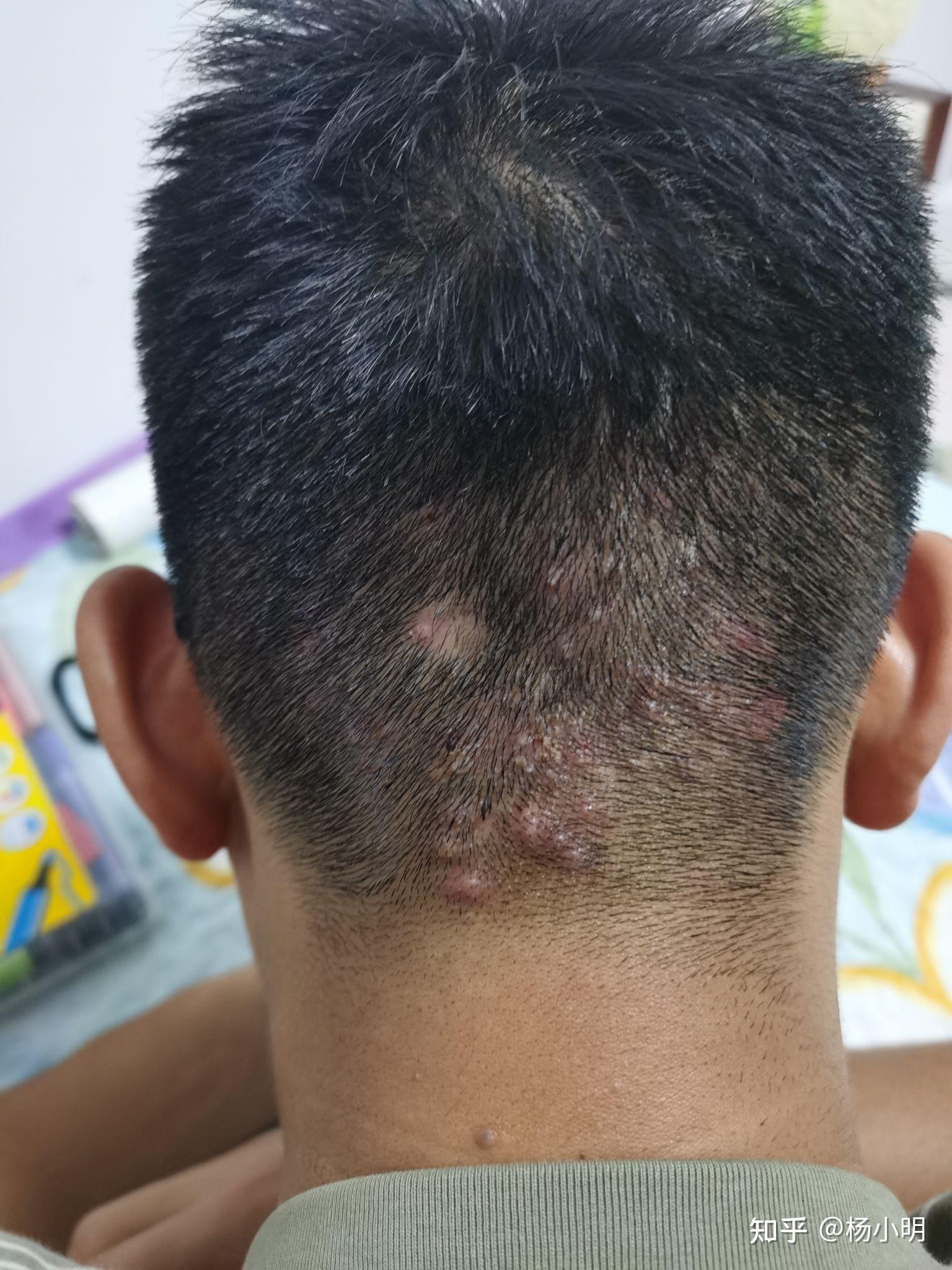 脑袋后面长了好多小疙瘩? - 知乎