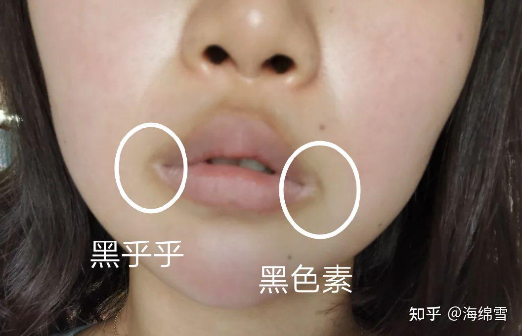 为什么嘴巴周围一圈皮肤特别黑? - 知乎