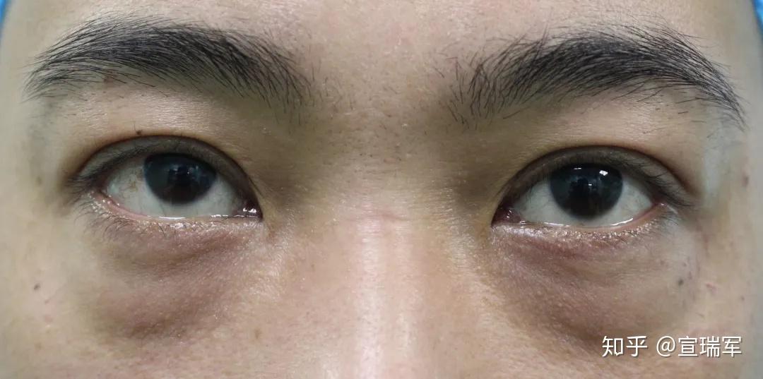 眼袋大面中凹陷的脸该如何改善?