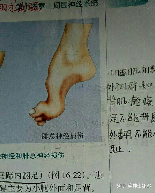 腓总神经受损脚趾脚面不能上抬能不能恢复