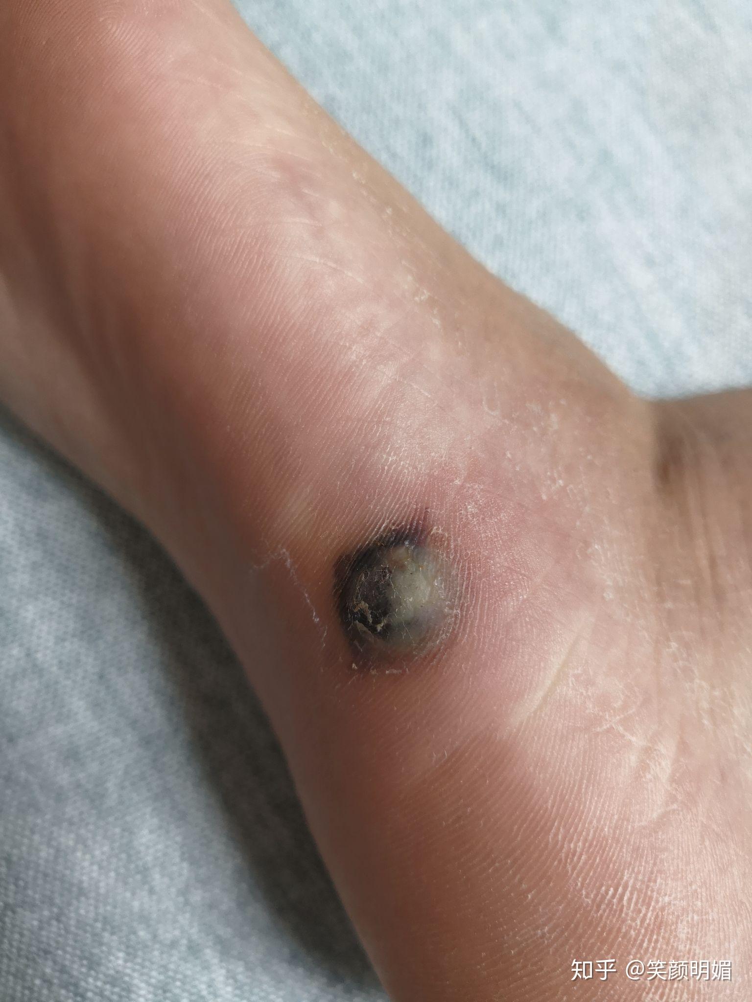 治疗足疣到底是激光,冷冻好还是药物涂抹? - 知乎