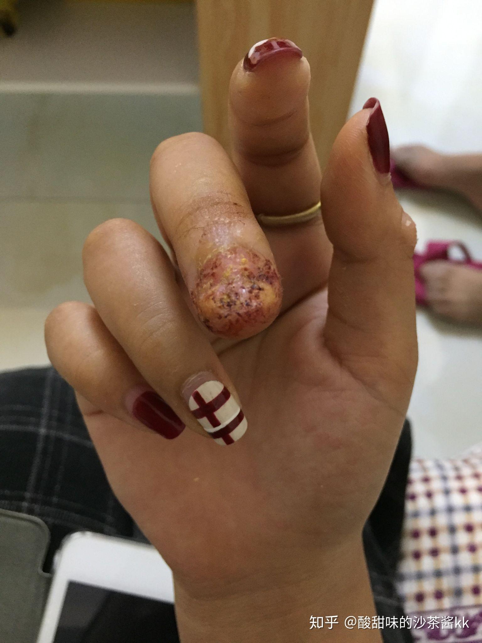 拔指甲是什么样的体验?很疼么? - 知乎