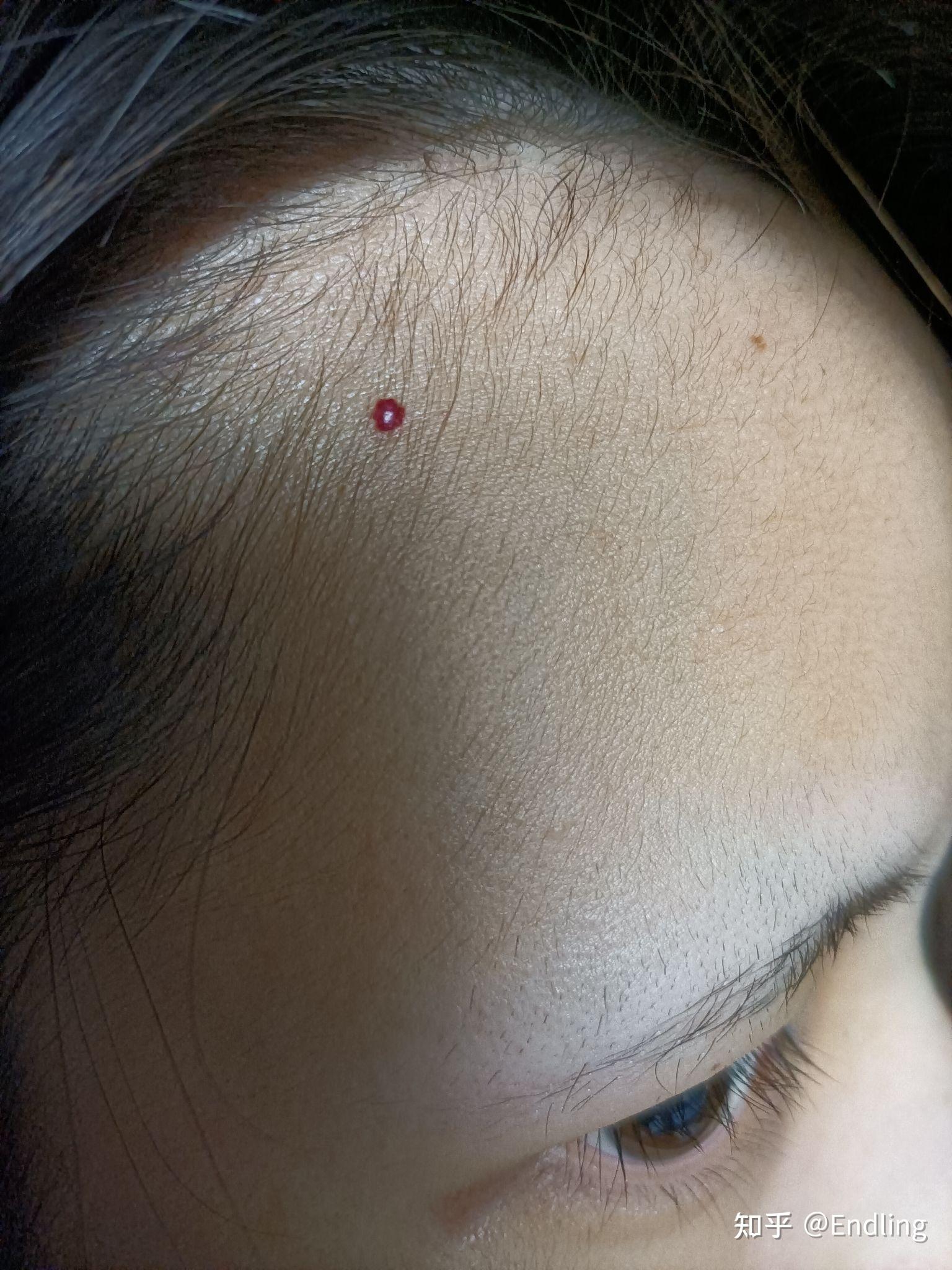 樱桃状血管瘤治疗都有什么办法大概的费用