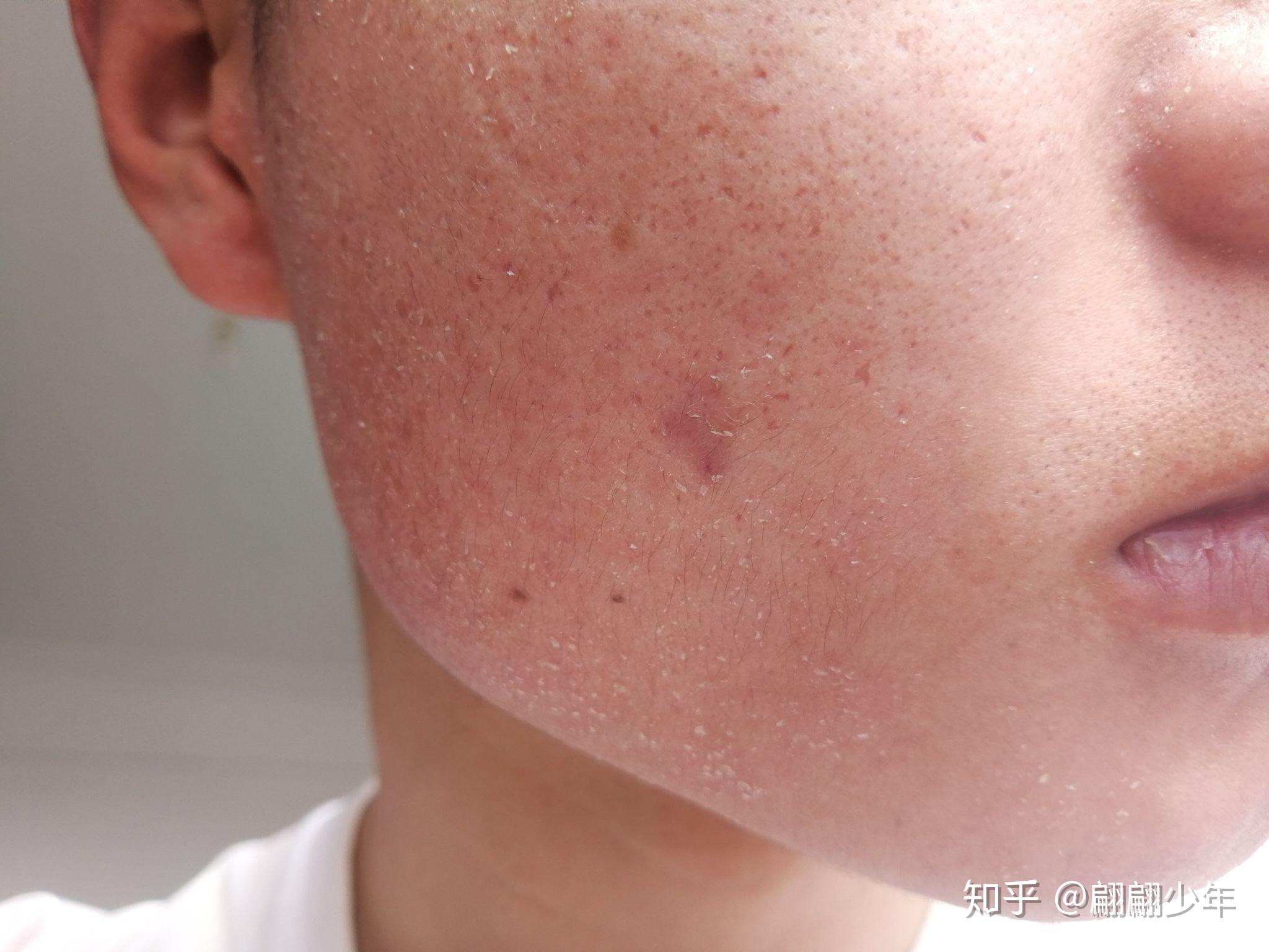 阿达帕林凝胶灼烧蜕皮? - 知乎