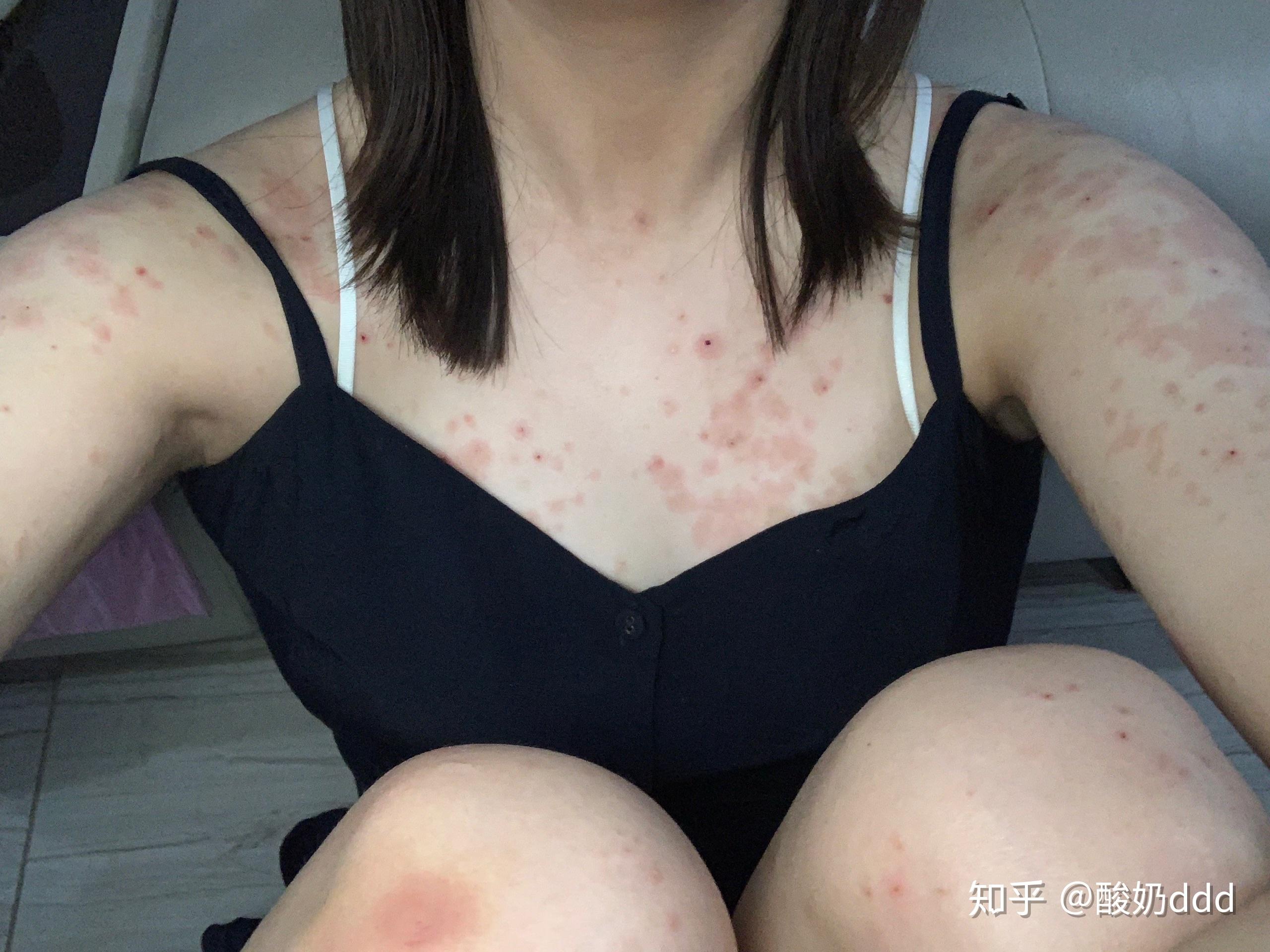 你见过哪些奇怪的过敏源