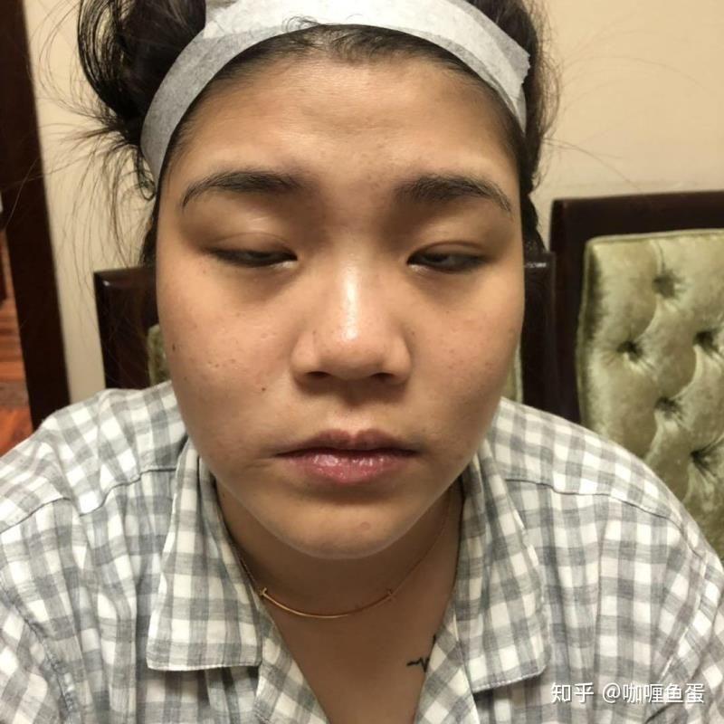 蒜头鼻怎样改善? - 知乎