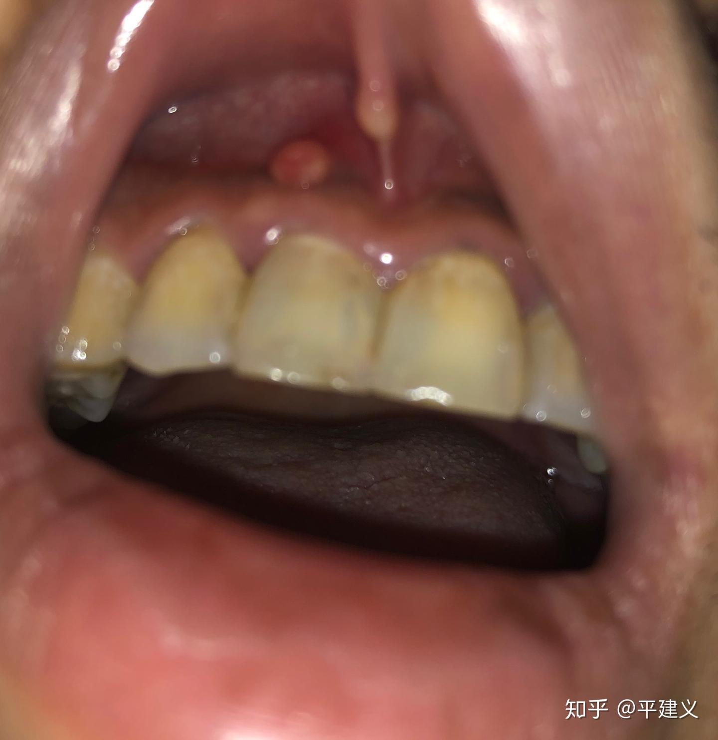 反反复复的慢性根尖周炎，治牙之路- 知乎