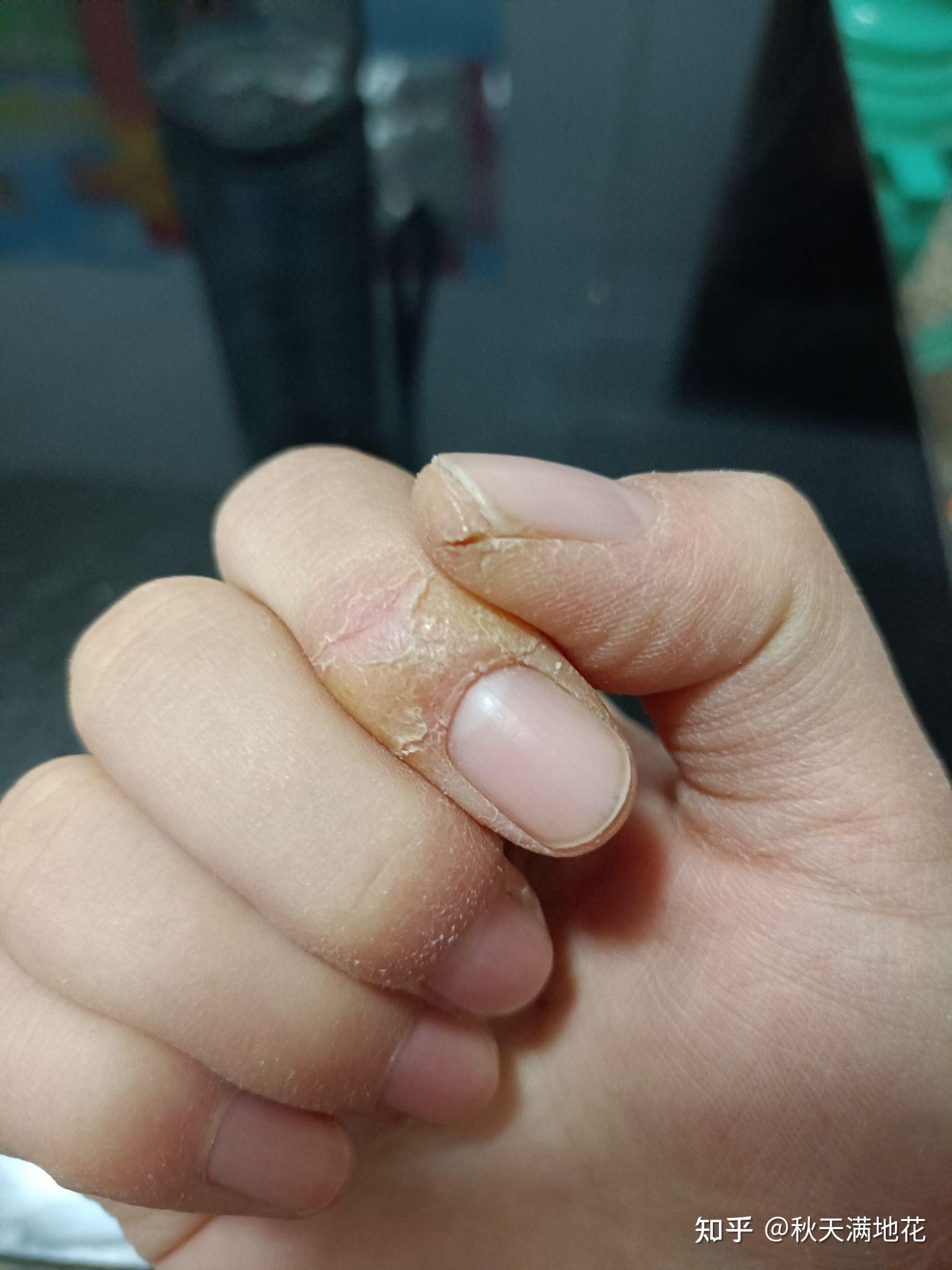 请推荐下老人冬天手脚皲裂得开口子流血的护理用的膏霜之类