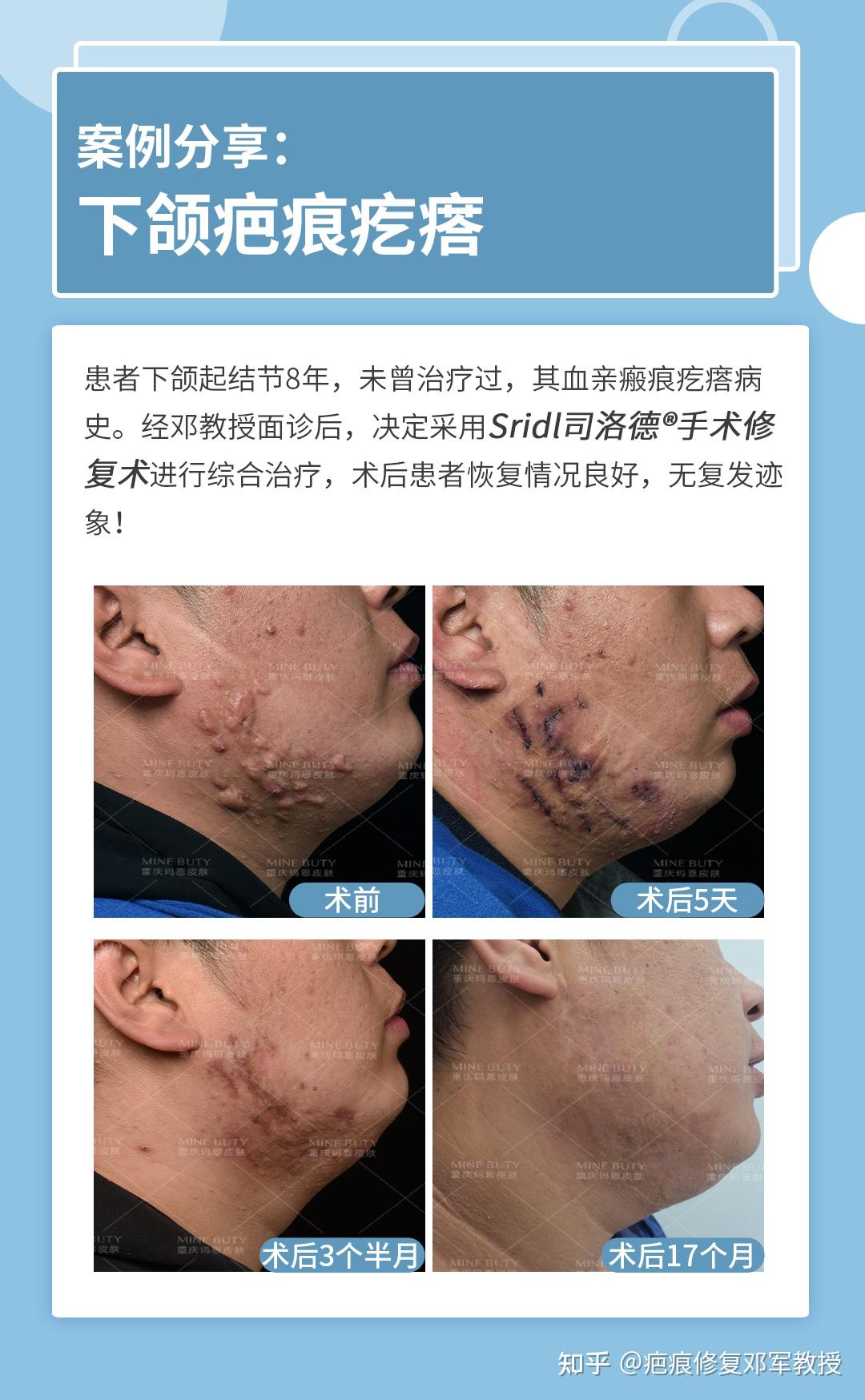 增生疤痕为什么会痒？ - 知乎