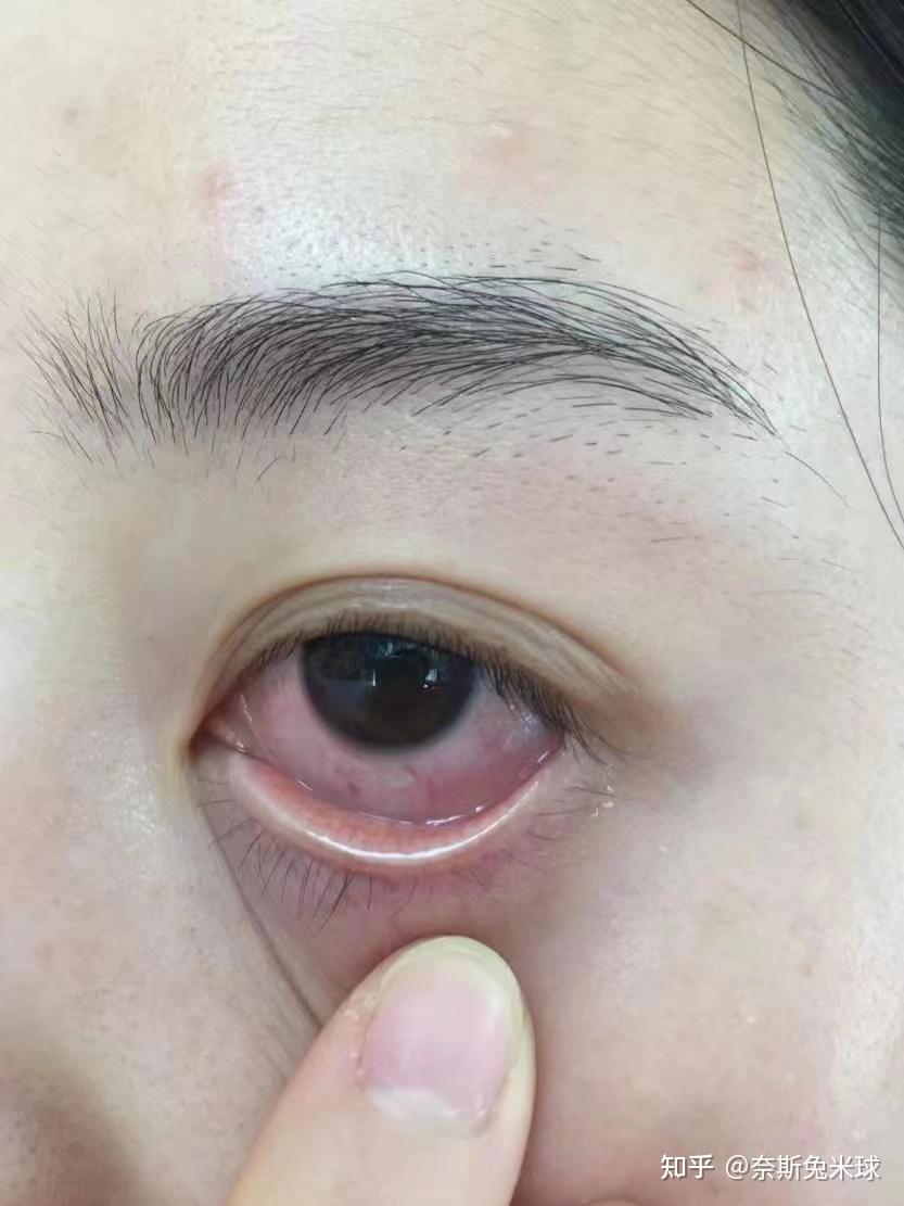 眼皮为什么肿了