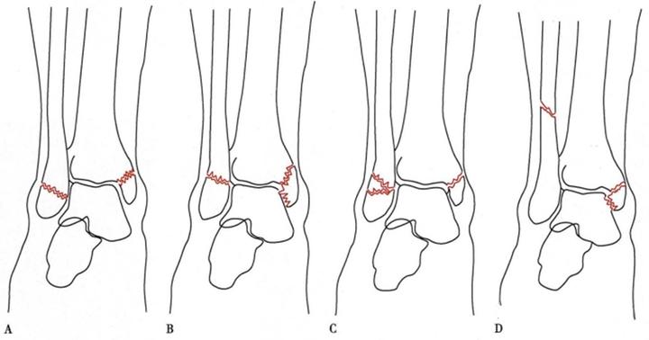 三踝骨折是什么?