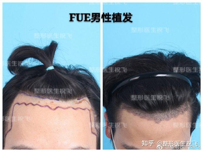 发际线美学丨什么样的发际线才是适合自己的? - 知乎