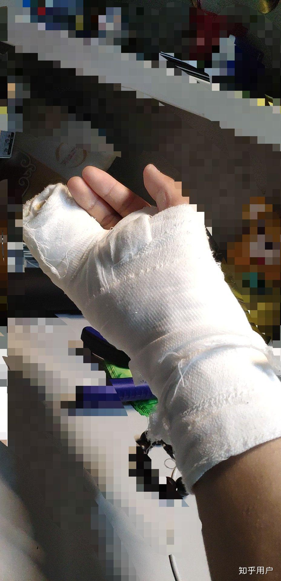 手指头骨折是种怎样的体验